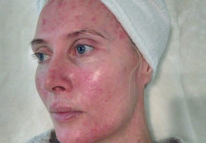 ‘Price to pay’ One Irish woman on the results of a life spent TANNING